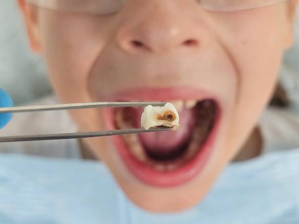 Best Emergency Tooth Extraction in Granite Quarry, NC