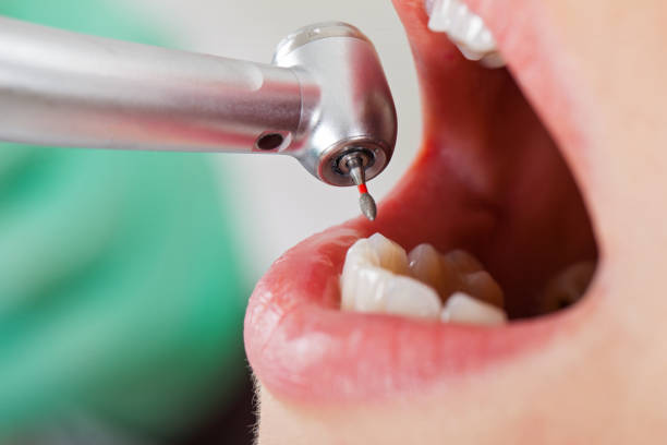 Best Emergency Treatment for Dental Infections or Abscesses in Granite Quarry, NC